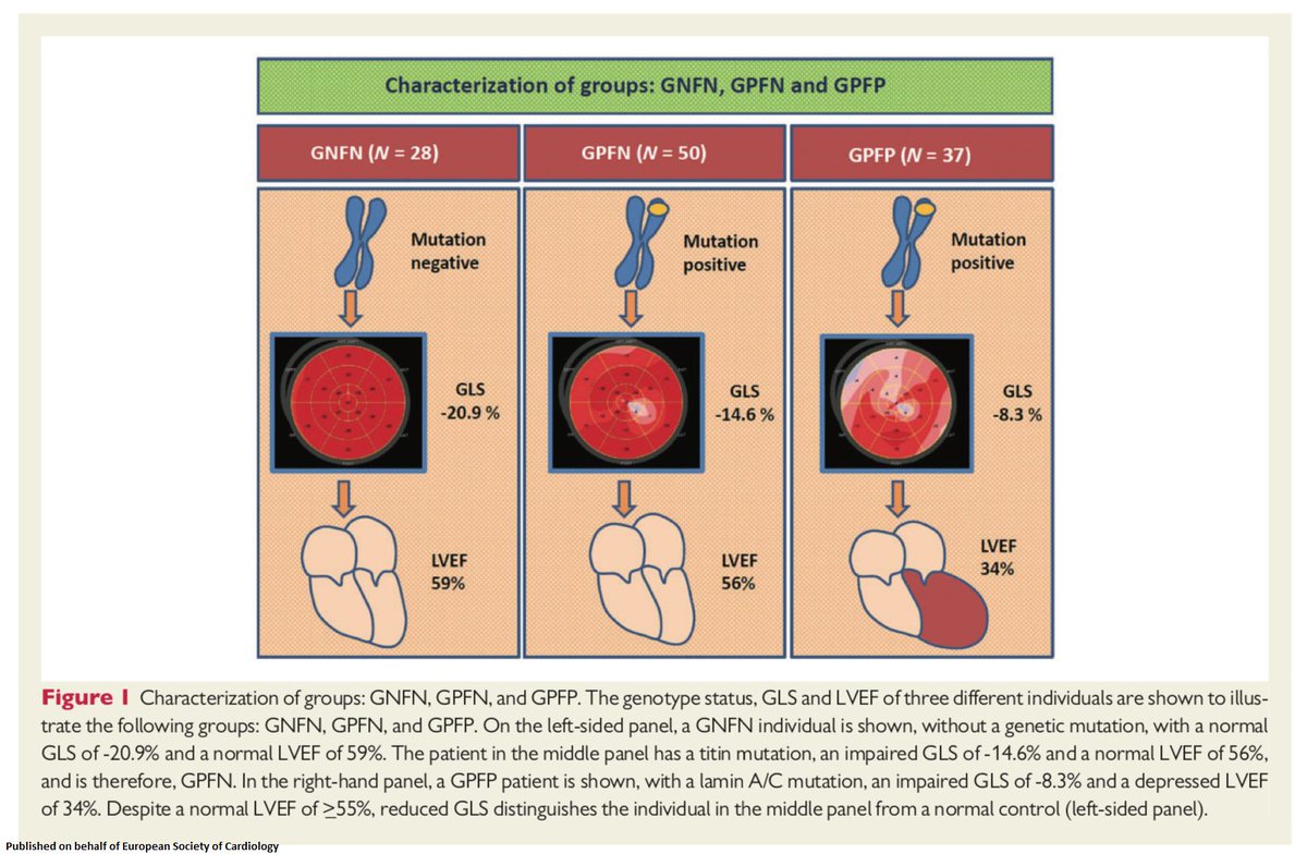 ESC_Journals's tweet photo. Left ventricular 2D speckle tracking #echocardiography for detection of systolic dysfunction in genetic, dilated cardiomyopathies https://t.co/7oswGVP1Z5 #EuroEcho
@escardio @GeraldMaurer #EACVI #EHJCVI #ESCCo #freeaccess https://t.co/yeQfx8qoRA