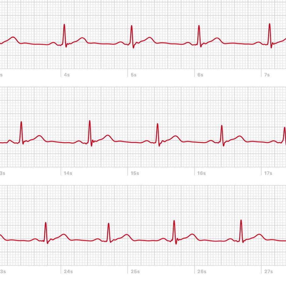 phyreous's tweet photo. Apple Watch finally sent out the update to give ECG app so I’ve been checking out my slow beating heart. https://t.co/FgWd0jVQ4Y