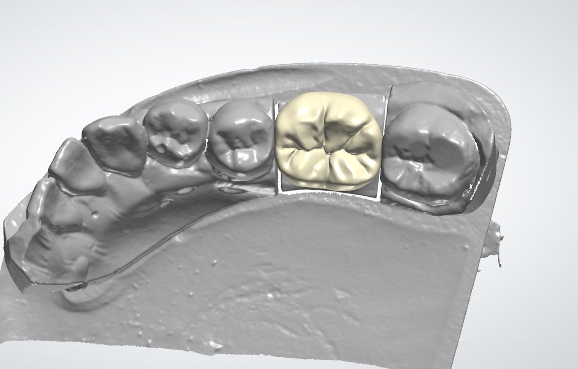 ImpChenCAD's tweet photo. I design full contour Zir crown and bridge on oral scan files. I have designed for many companies in foreign country to build up from 0 to 500 units per month. 5USD each unit for design. If you are interested in it, I can send you photo or files of cases we did. Thank you! https://t.co/VdyQ4r3AjK