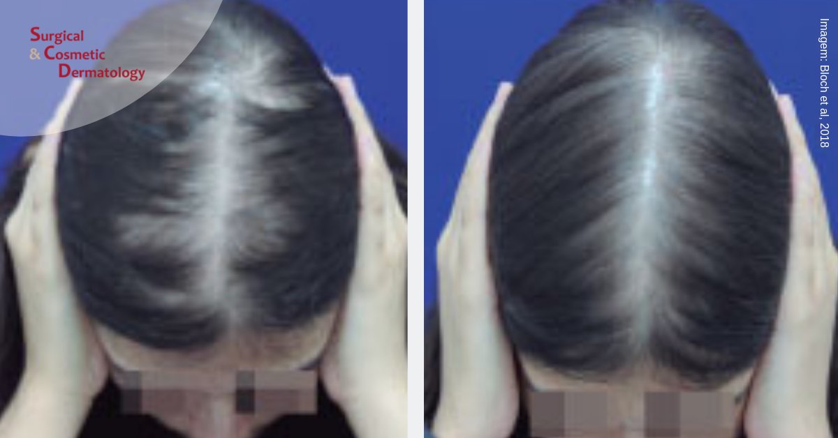 Finasteride Mas Barato