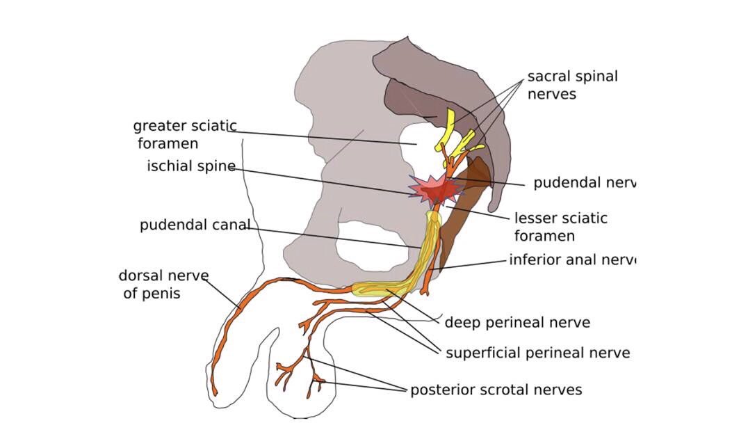 Pudendal nerve entrapment (or pudendal neuralgia), a relatively mis-understood condition in bikefitting.

Not the diagnosis in everyone with saddle related issues, but an important condition to have awareness of. 

Especially when there are low pressures on saddle mapping!