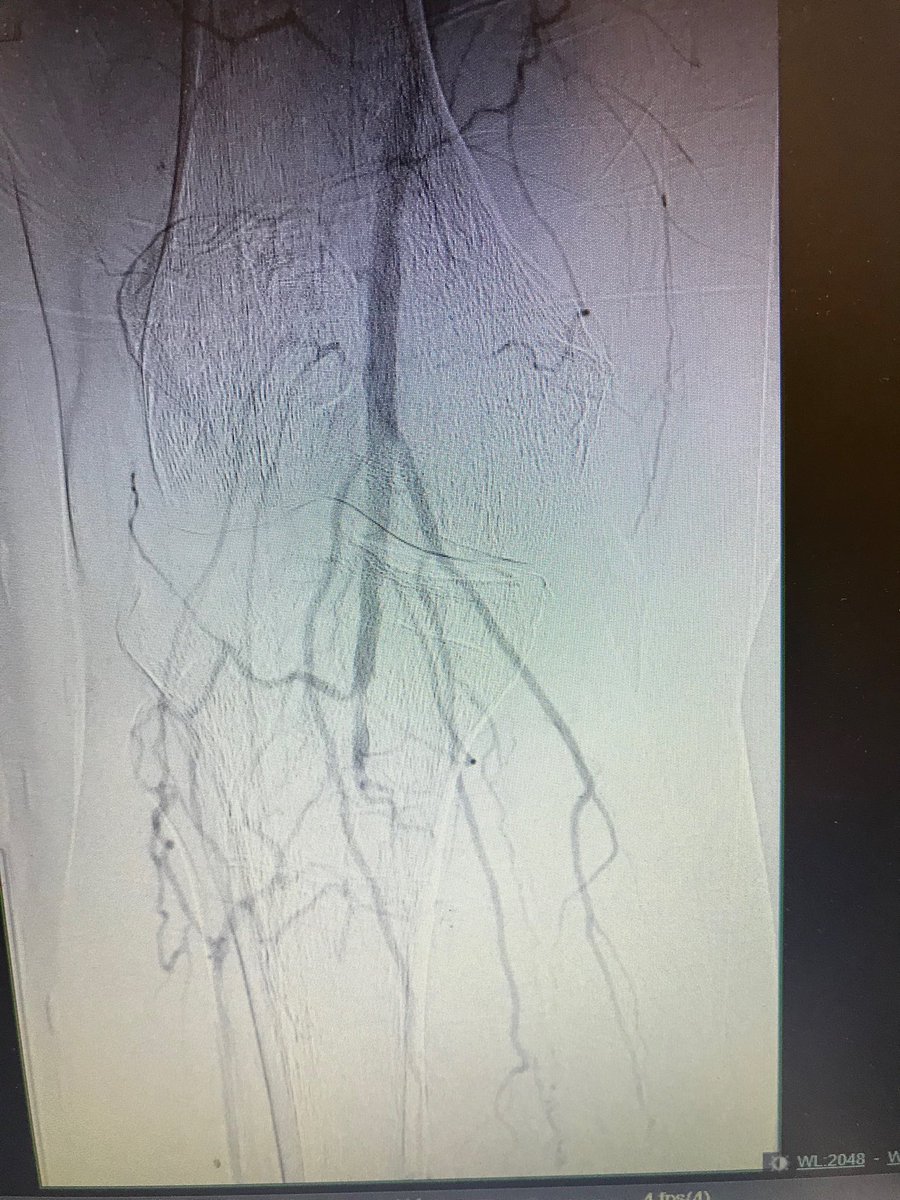 istentem's tweet image. #pad #cardiotwitter#cto. 55 m dm, claudicant.no runoff.#pedalaccess , Antero and retro approach. #doubleballoon , #safari .#dcb.#supera .good dp pulse. Home same day.