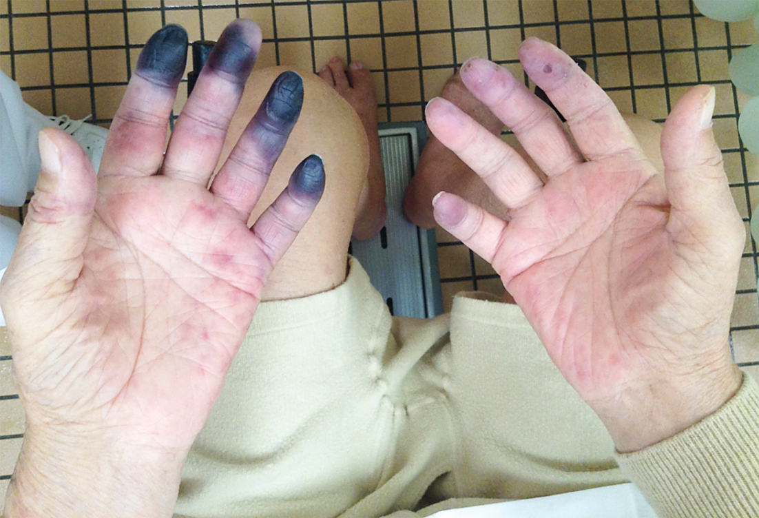 NEJM's tweet image. New Image Challenge: What&apos;s the diagnosis? Read the case details and submit your answer: nej.md/pPbCdb