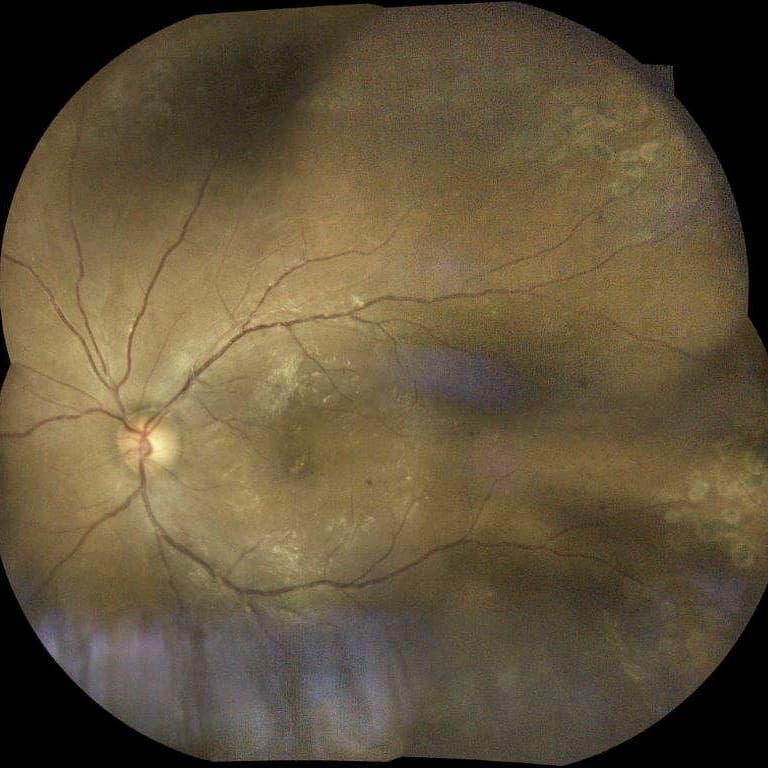 Reposting @lisawahlod:
'Wide Field Fundus Photos of a patient with proliferative diabetic retinopathy s/p PRP OU.
#diabeticretinopathy #fundus #fundusphoto #eidon #retina #diabeticawareness #eyedoc #eyecare'