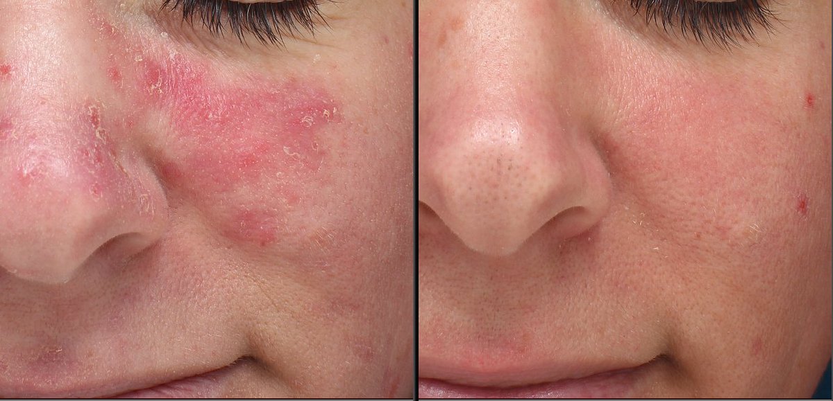 GsySkinBeauty's tweet photo. Do you want to see real changes to your skin?

This transformation was using ZO Skin Health products only.

Limited spaces left for the remainder of the year. Book now to avoid disappointment. https://t.co/yNp1RBWjkJ