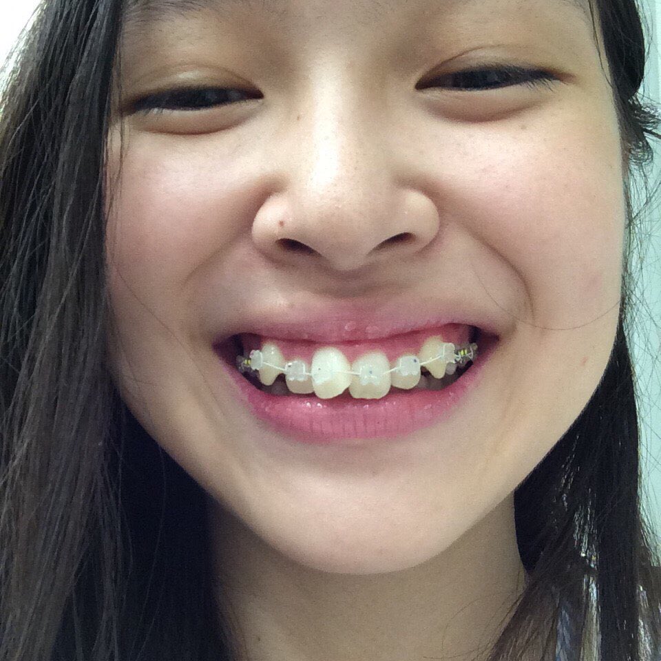 ギズモ 歯列矯正している女の子しか入れないアイドルグループ 矯正少女 っていうのを考えた 矯正期間中だけの活動で ブラケット マウスピースが外れる頃には 強制 で卒業 さ学システム T Co Afb8zcn3l4 Twitter