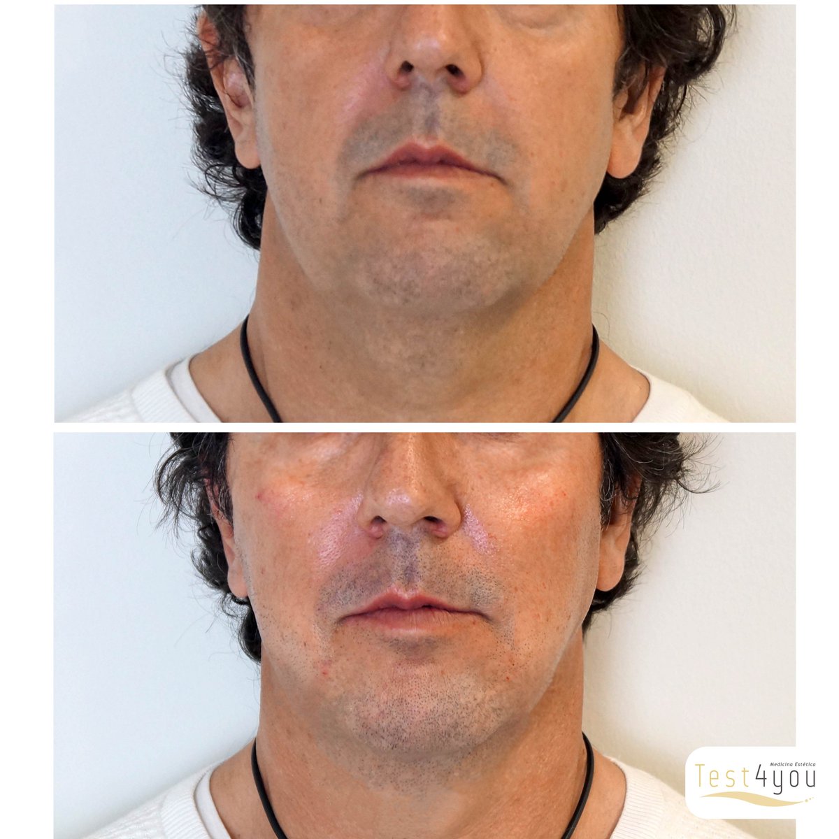 ClinicaTest4You's tweet photo. Cada vez son más los #hombres que deciden cuidarse, llevar una vida sana y mejorar su aspecto a través de la medicina estética.

En #Test4You, SEAS EL HOMBRE QUE SEAS, tenemos el tratamiento perfecto para ti.

Infórmate 955236868 - https://t.co/kfzXjSxrvA

#HilosTensores #Sevilla https://t.co/Aox2j5QMgJ