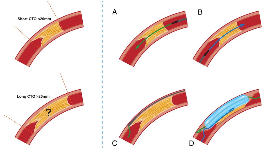 A #retrogradeapproach adopted for #chronictotalocclusion procedures in 2007 at a high-volume center in #Korea was associated with increased technical success but no better in-hospital outcomes than with the antegrade-only approach. Read more: qoo.ly/u7dug