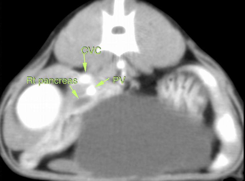 ValeReferrals's tweet image. Find out why Internal medicine clinician Sian Blakey needed to perform a percutaneous, ultrasound guided, drainage of a cyst... valereferrals.co.uk/news/155-encap…