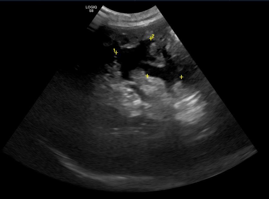 ValeReferrals's tweet image. Find out why Internal medicine clinician Sian Blakey needed to perform a percutaneous, ultrasound guided, drainage of a cyst... valereferrals.co.uk/news/155-encap…