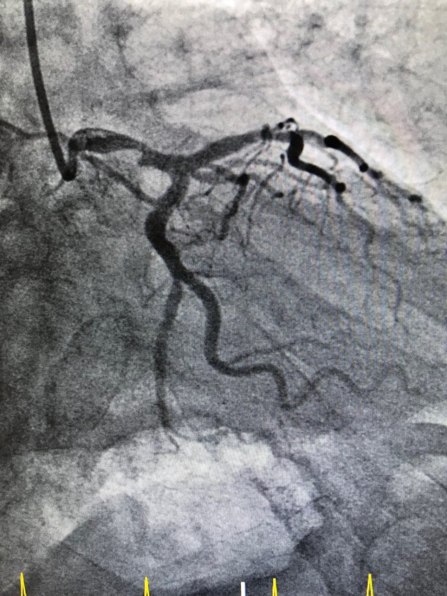 istentem's tweet image. #radialfirst.69m, new onset afib, minor symptoms, trop 8, Nl LV and rca.rt  radial, no support.ivus. 5x12 onyx