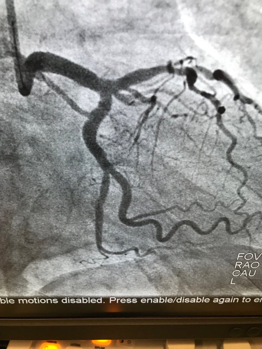 istentem's tweet image. #radialfirst.69m, new onset afib, minor symptoms, trop 8, Nl LV and rca.rt  radial, no support.ivus. 5x12 onyx