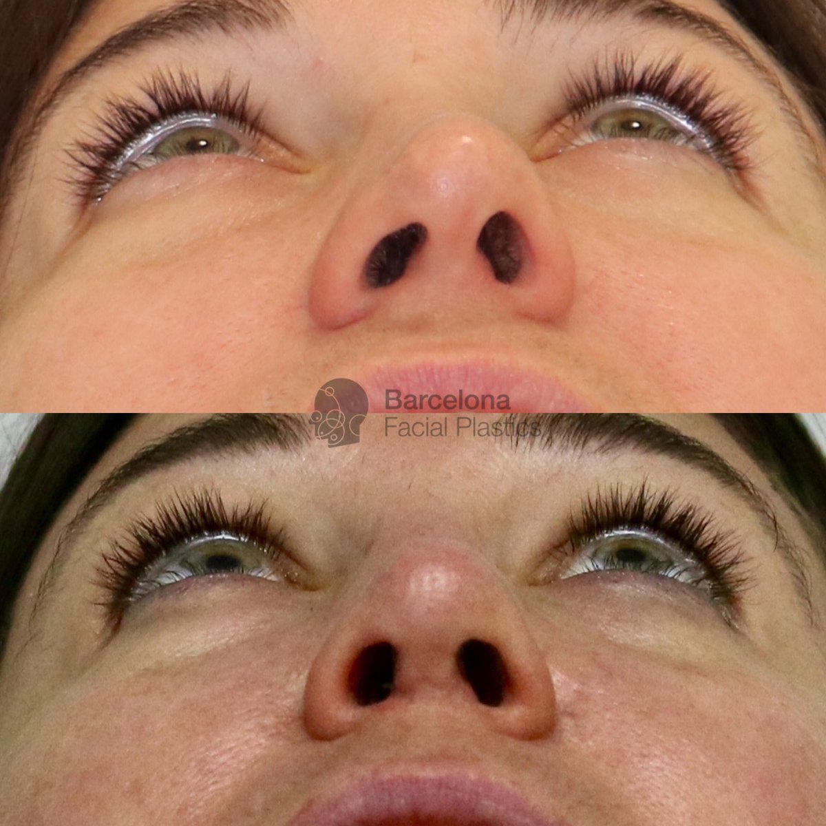 Barcelona Facial Plastics ٹوئٹر پر Os Presentamos Otro Caso De Rinoplastia Ultrasonica Caso Nariz Desviada Con Giba Y Punta Rotada Operacion Rinoplastia Estetica Y Funcional Resultado Perfecto Y Natural Rinoplastia