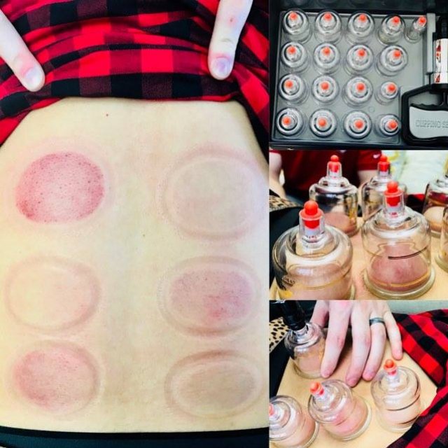 alphasports__'s tweet photo. Get cupped for Christmas! 

#alphasports #cuppingtherapy #chiropractic #recovery #cupping https://t.co/xxKYYuFdZU