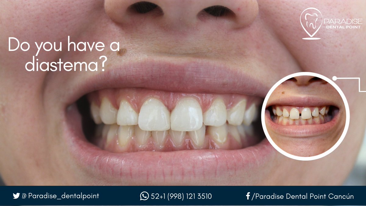PDentalpoint's tweet photo. Which is the best treatment for the diastema? Re-tweet us for more information #FamilyOfDentists #Cancun #Diastema 
-
Follow us on Facebook:
➡️https://t.co/02sVGyZdQI https://t.co/rGKDLCeczL