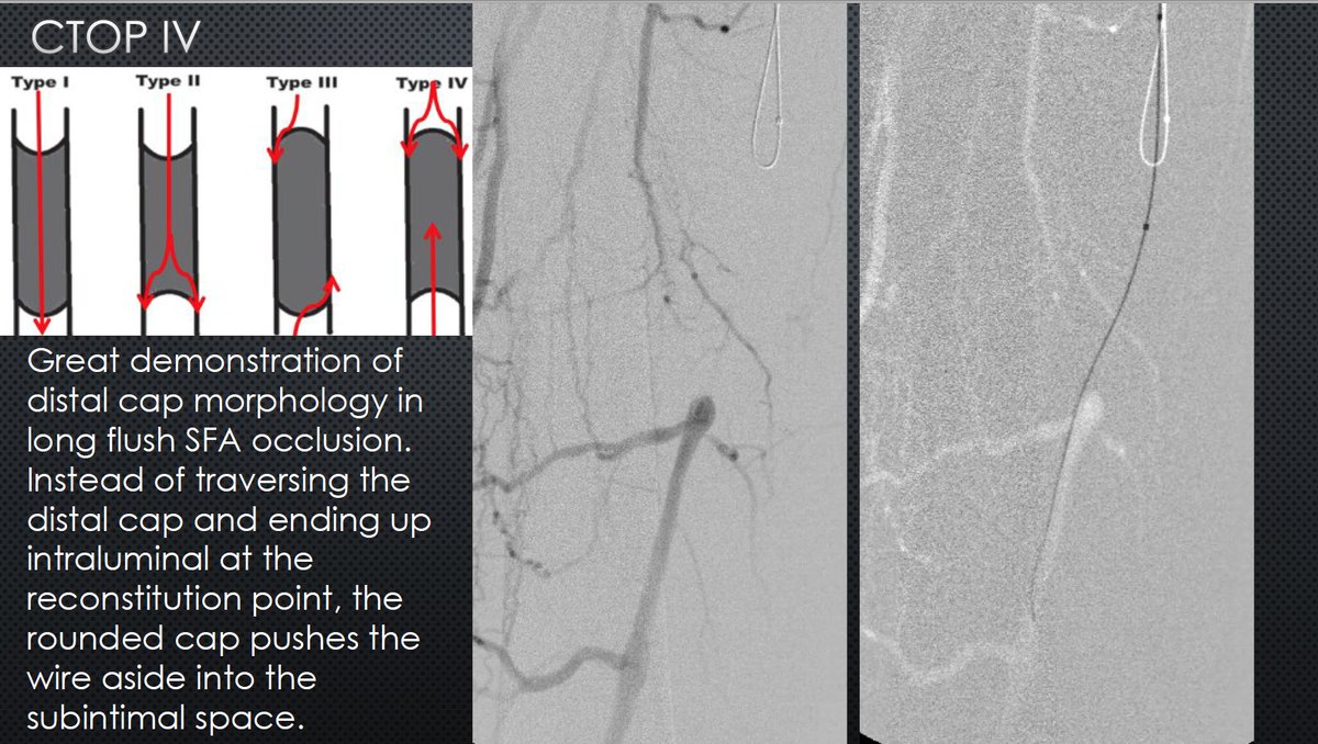 Watts_IR's tweet image. The best example of CTOP IV I've seen clinically. Know the techniques! Procedures failed by others become routine when you understand the pathology. #CLIFighters #MyLegMyLife #Can'tCTOPWon'tCTOP @SOBE_Vascular @kmadass @SDhandMD @Mustapja @FadiSaab17 @LessneVIR @SIR_ECS @SIRRFS