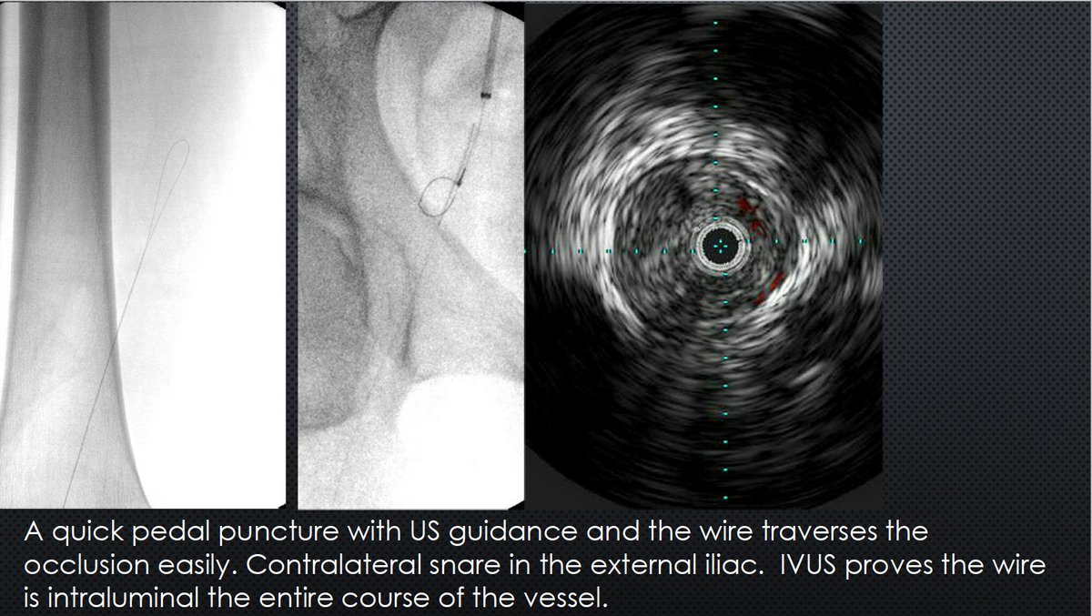 Watts_IR's tweet image. The best example of CTOP IV I've seen clinically. Know the techniques! Procedures failed by others become routine when you understand the pathology. #CLIFighters #MyLegMyLife #Can'tCTOPWon'tCTOP @SOBE_Vascular @kmadass @SDhandMD @Mustapja @FadiSaab17 @LessneVIR @SIR_ECS @SIRRFS