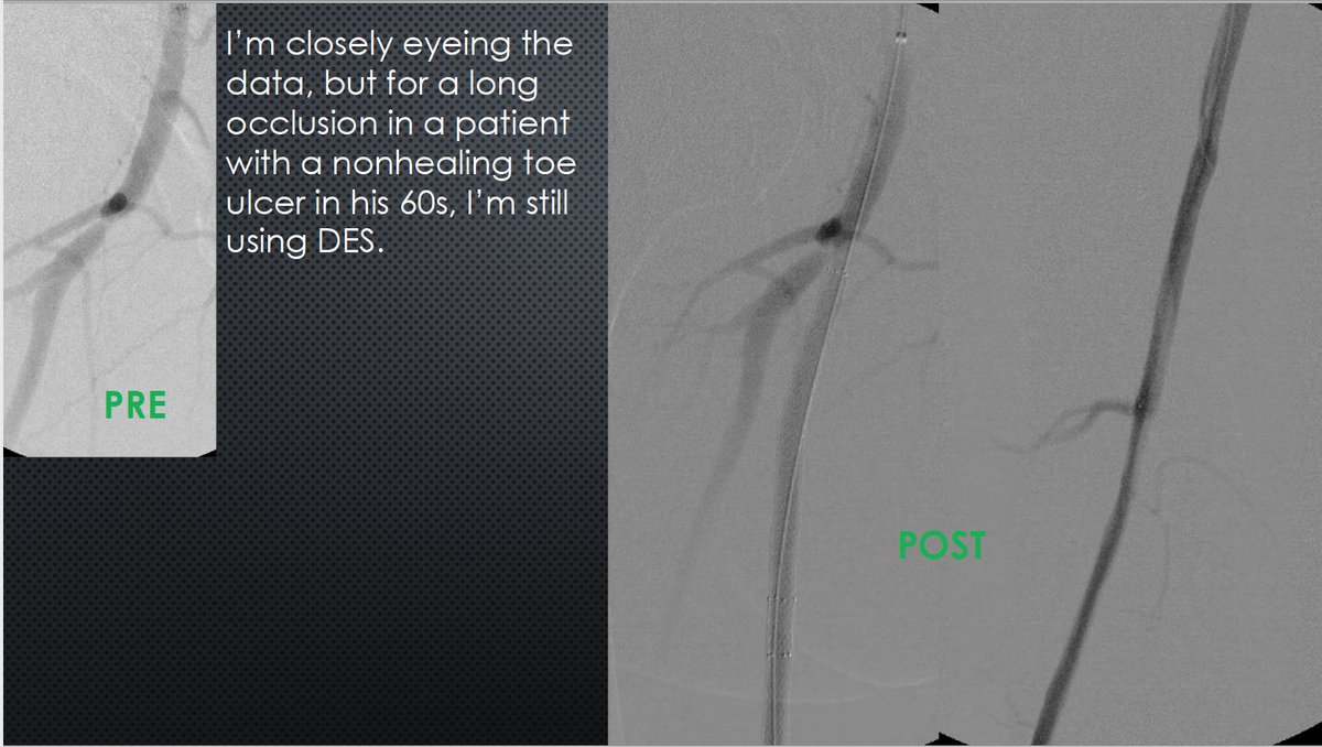 Watts_IR's tweet image. The best example of CTOP IV I've seen clinically. Know the techniques! Procedures failed by others become routine when you understand the pathology. #CLIFighters #MyLegMyLife #Can'tCTOPWon'tCTOP @SOBE_Vascular @kmadass @SDhandMD @Mustapja @FadiSaab17 @LessneVIR @SIR_ECS @SIRRFS