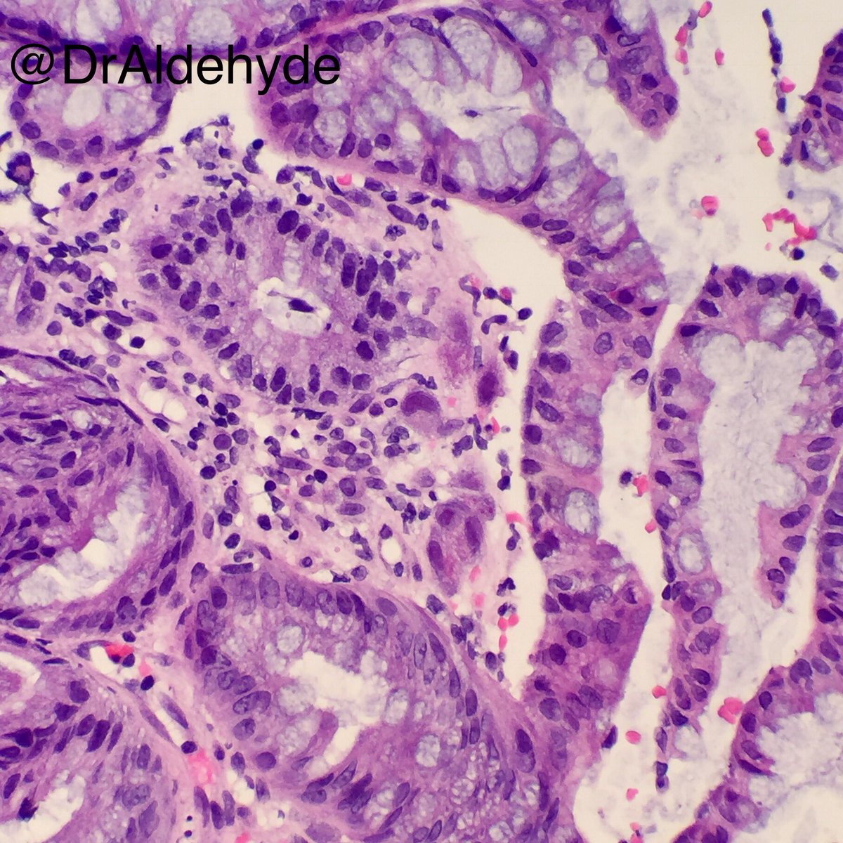 DrAldehyde's tweet image. Friday special. 😆🔬

CMV colitis showing characteristic infected cytomegalic cells with basophilic intranuclear inclusions surrounded by a clear halo + smaller granular intracytoplasmic inclusions

#GIPath #PathBugs #crittersontwitter #PathArt 🐛🎨