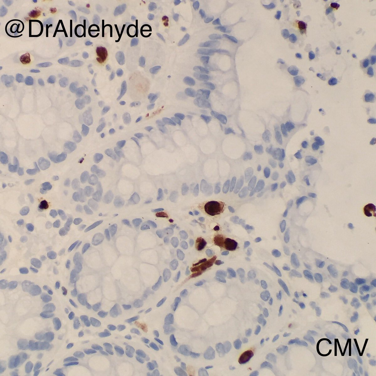 DrAldehyde's tweet image. Friday special. 😆🔬

CMV colitis showing characteristic infected cytomegalic cells with basophilic intranuclear inclusions surrounded by a clear halo + smaller granular intracytoplasmic inclusions

#GIPath #PathBugs #crittersontwitter #PathArt 🐛🎨