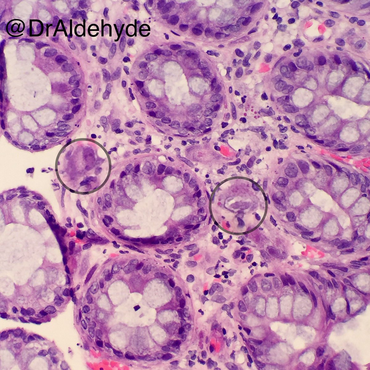 DrAldehyde's tweet image. Friday special. 😆🔬

CMV colitis showing characteristic infected cytomegalic cells with basophilic intranuclear inclusions surrounded by a clear halo + smaller granular intracytoplasmic inclusions

#GIPath #PathBugs #crittersontwitter #PathArt 🐛🎨