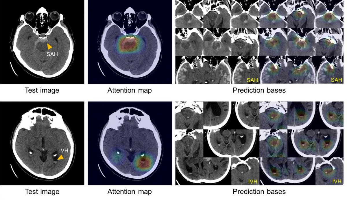 thanegn's tweet photo. Artificial intelligence system learns to diagnose, classify intracranial hemorrhage - EurekAlert https://t.co/R3Mil4r1gD https://t.co/yoyW7bCC9N