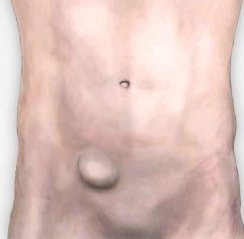 #hernia is the result of a weakness in the abdominal wall. 

#Inguinal #hernias relate to a weakness where the pipework to and from the testicle pass through the abdominal wall in men, and the round ligament of the uterus in the female.