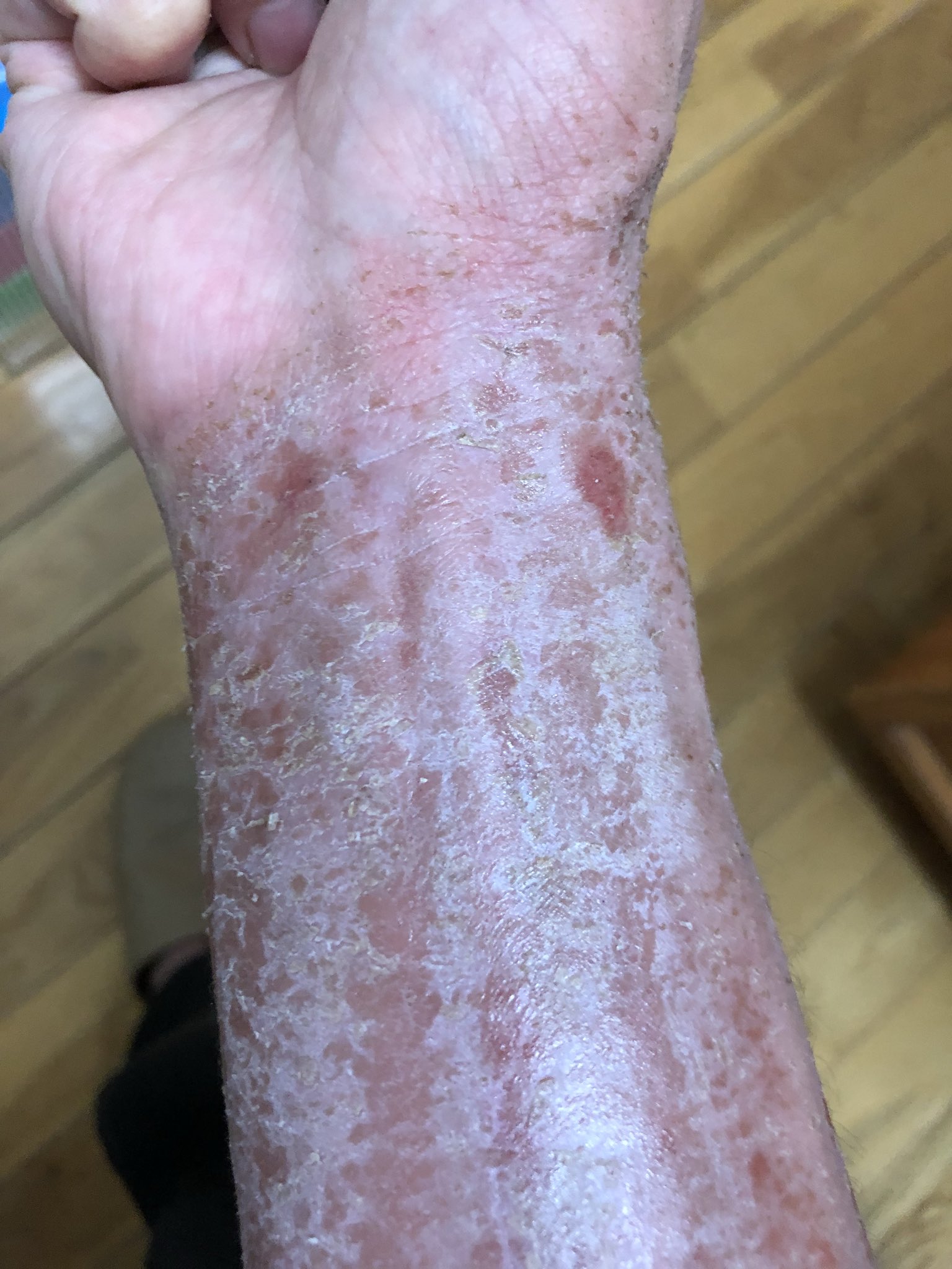 アトピー完治への軌跡 ステロイドを使わない治療でアトピー がこんなに良くなるとは 二ヶ月でこんなに良くなった 自分でもびっくり 岐阜県のナチュラルクリニック21てとこに入院してます アトピー完治への軌跡 ステロイドを使わない治療でアトピー がこんなに良くなるとは 二ヶ月でこんなに良くなった 自分でもびっくり 岐阜県のナチュラルクリニック21てとこに入院してます