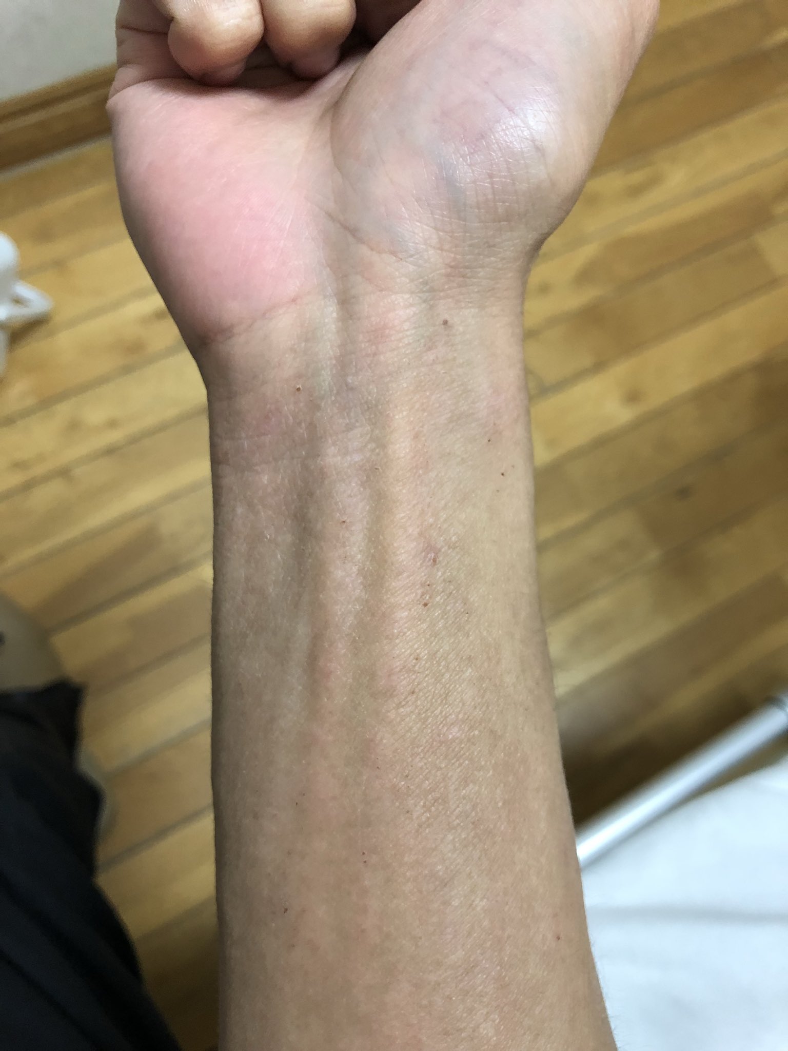 アトピー完治への軌跡 ステロイドを使わない治療でアトピー がこんなに良くなるとは 二ヶ月でこんなに良くなった 自分でもびっくり 岐阜県のナチュラルクリニック21てとこに入院してます アトピー完治への軌跡 ステロイドを使わない治療でアトピー がこんなに良くなるとは 二ヶ月でこんなに良くなった 自分でもびっくり 岐阜県のナチュラルクリニック21てとこに入院してます
