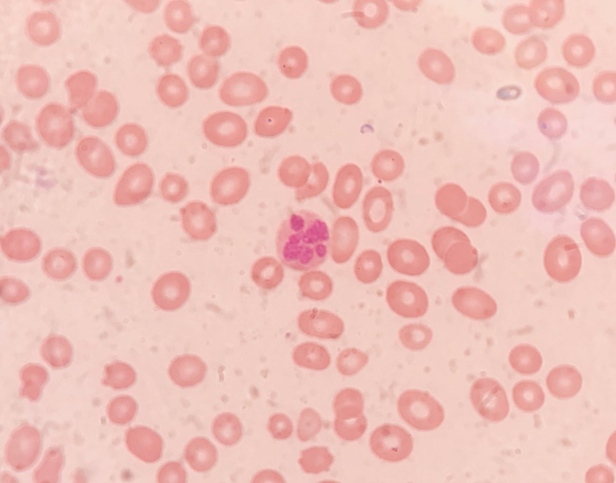 GomezDLeonMD's tweet photo. Pancytopenia... glad to see this little dude when no B12/folate levels are readily available #heme #hematology #anemia #B12... treating with a single megadose of cobalamin #savebutts https://t.co/wZM9XCakEw