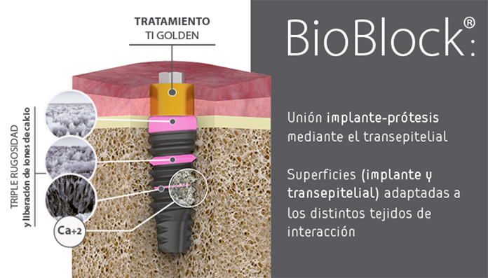 BTIBiotech's tweet photo. Repasamos las novedades de producto BTI de 2018: #BioBlock - Transepiteliales #UNIT. Creación de una interfase implante prótesis con garantía de hermetismo, evitando la invasión bacteriana. https://t.co/4w6C0XgaoC #BTI2018 https://t.co/cWgMueZDSI