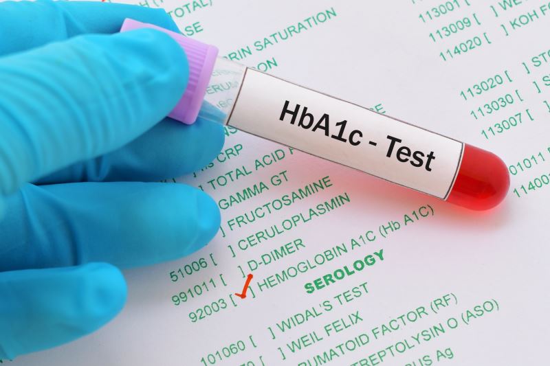 direct2lab.in/2018/12/10/eve…
HbA1c is a marker that reflects your average blood sugar levels in the previous 3 months. It’s also called glycated hemoglobin, hemoglobin A1c or just A1c. HbA1c is a strong predictor of various major health issues related to diabetes.