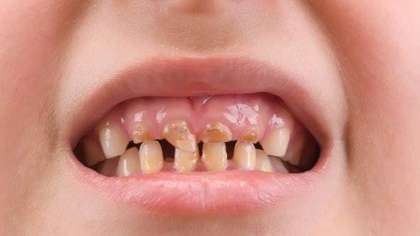 Shocking figures showing the number of full mouth clearances of children under 10 have hit the headlines again. 

More investment in #NHS dentistry will help save young patients' teeth. bit.ly/2AUilH9