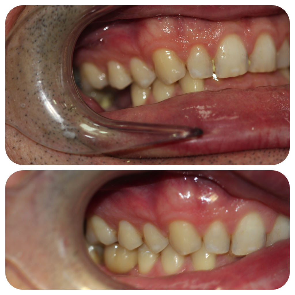 CocoonaClinic's tweet photo. Replacement of missing molar tooth with implant supported crown by Dr. Ashee Rajabali

#cocoonaclinic #drashee #implantologist #toothreplacement #dentist #dental #teeth #hollywoodsmile https://t.co/Gtj7zCSh7h