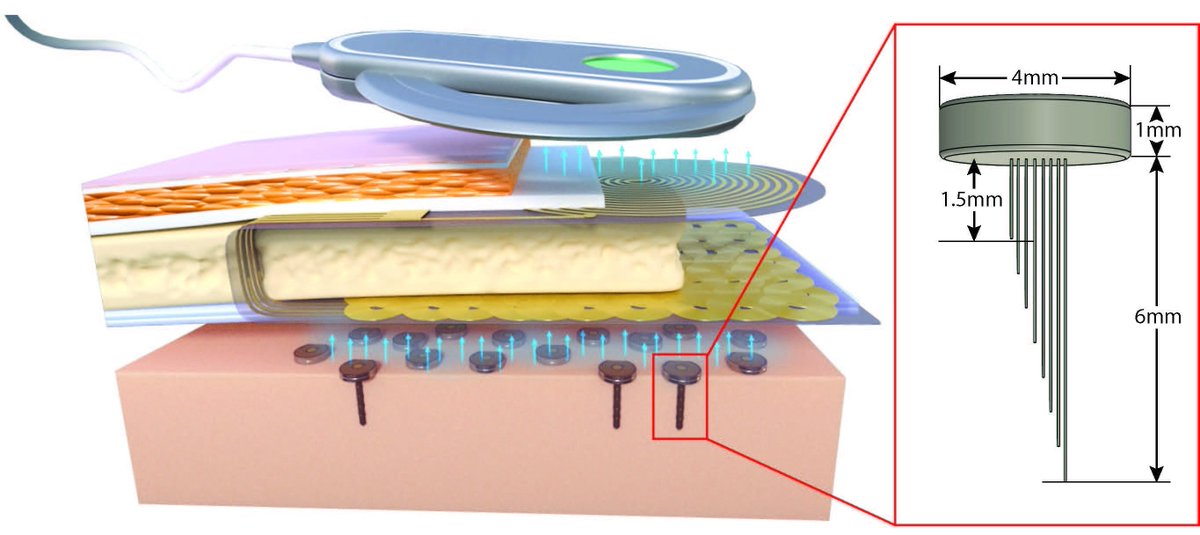 Paper 1/3 #NER19 Recent progress on our #ENGINI (mm-scale wireless implant) platform: “Towards a Distributed, Chronically-Implantable Neural Interface” <a href="/imperialcas/">Circuits and Systems</a>