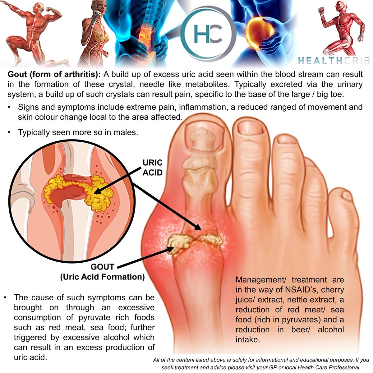 Healthcrib_fdt's tweet photo. THE FOOT: #gout can be a real pain in the #foot
.
Be sure to check out some of the signs, symptoms and support that can be use to aid recovery
.
#healthcrib #ankle #run #alignment #footsprains #footwear #footrecovery #plantarfasciitis #footexercise #footexercises #uricacid https://t.co/iaklOlAMZ9
