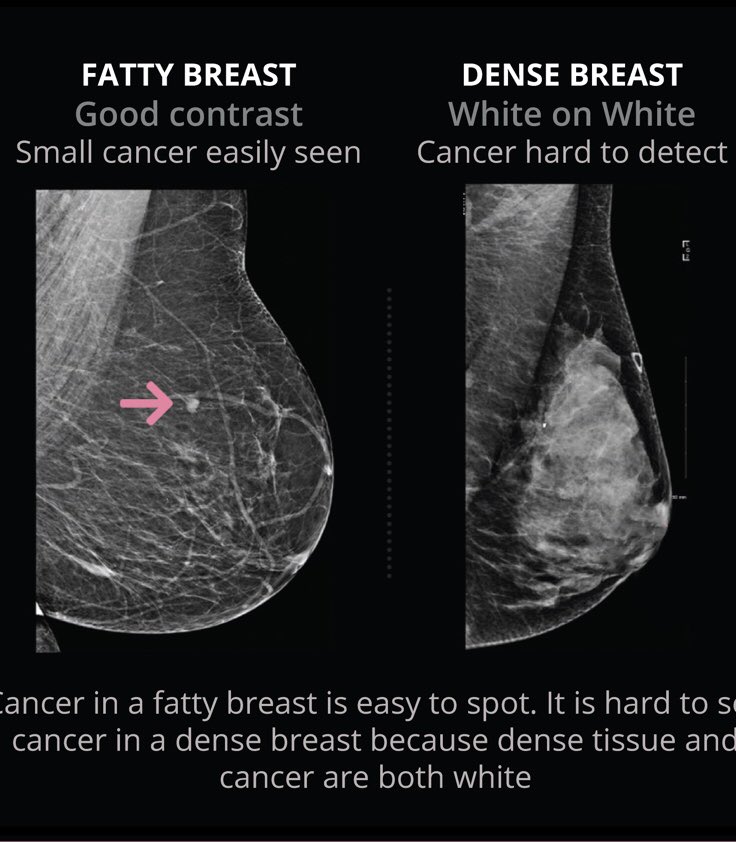 Dr. Paula Gordon on X: There's a big cancer hiding in the dense breast on  the right. See it? Half of cancers in dense breasts are missed. So why  doesn't @cantaskforce think