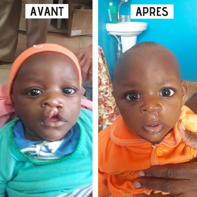 تويتر La Chaine De L Espoir على تويتر Au Printemps Dernier Nous Vous Alertions Au Sujet De Ce Petit Malien Qui Souffrait D Une Malformation Grave Au Visage Une Fente Labio Palatine Egalement