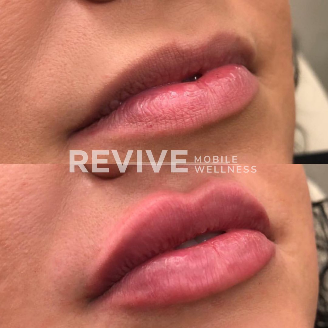 ReviveMobile's tweet image. First time lip fill for this beauty just in time for holiday parties. 🎄🎁🥂  1 ml Juvederm  Vollure used for Cupid’s bow definition, hydration, and plumping💉💋 ✨ 
#revivemobilewellness #nurseinjector Book online at 👇revivemobilewellness.com