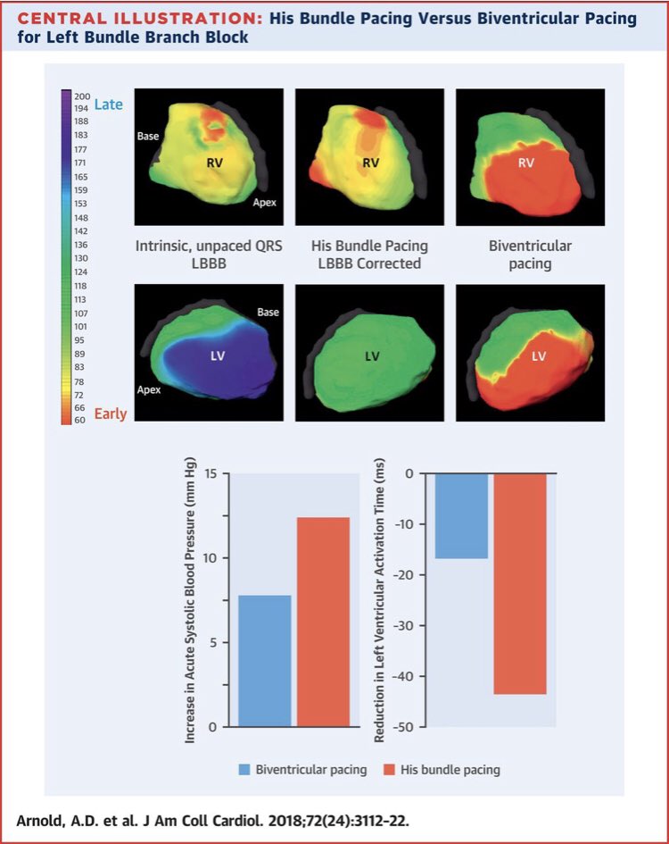 DrAfzalSohaib's tweet photo. ECGI showing superiority of LV activation with His paced reversal of LBBB compared to CRT. And better haemodynamics!!  https://t.co/x43s3o5ltK #dontdisthehis https://t.co/jPeDx0e43j