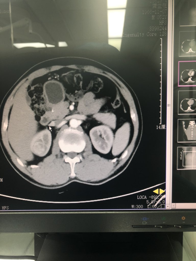 jianyong_tong's tweet image. retroperitoneal laparoscopic partial nephrectomy。Renal artery clamping time 20 min.