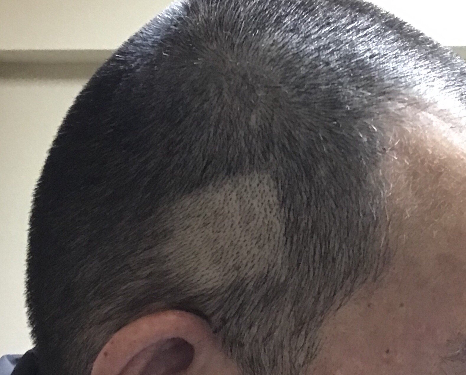 オレンヂ 自分で髪を坊主にしていたらバリカンの長さ指定アタッチメントが外れてもろに頭を削ってしまった写真をご覧ください T Co G3em8llqdk Twitter