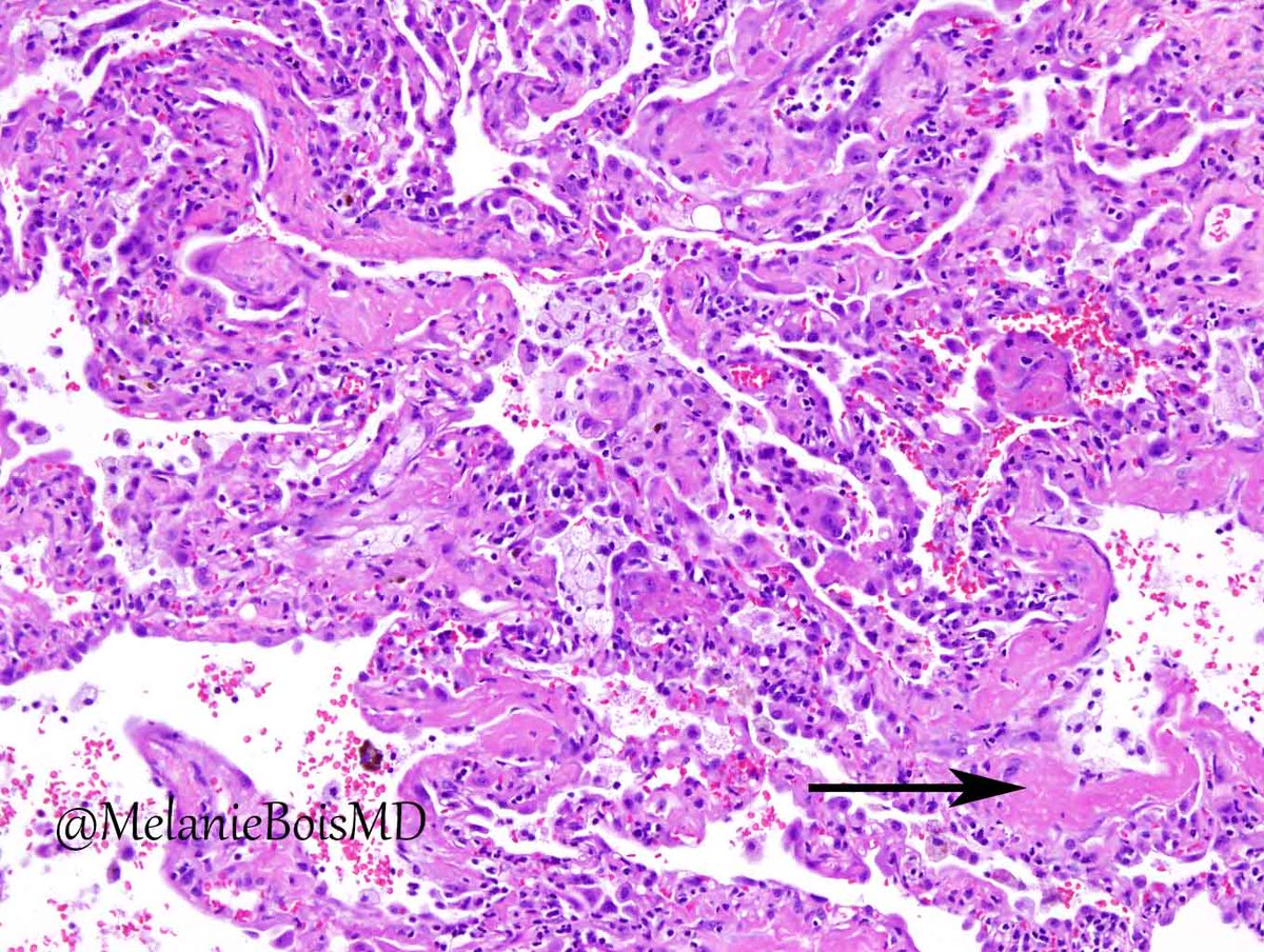 MelanieBoisMD's tweet photo. I first learned about diffuse alveolar damage from @aubry_mc when she described hyaline membranes as thick toothpaste lining the alveolar spaces (arrow). That analogy has always stuck with me and is just one example of how positive mentorship shapes your career. @MayoClinicPath https://t.co/QVqtcmM0fL