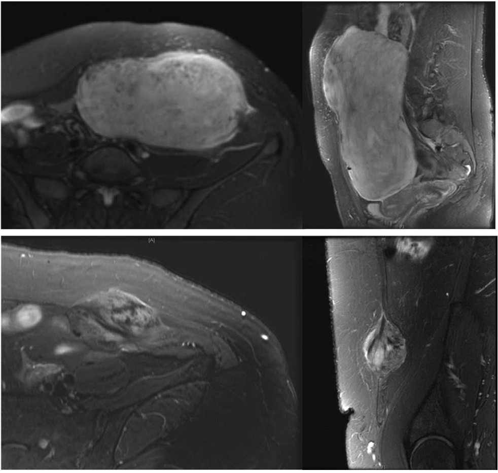 Annals of Surgery (@annalsofsurgery) on Twitter photo Researchers at @sloan_kettering have shown that MRI characteristics can predict which desmoid tumors fail an observation strategy: Read their full paper at: journals.lww.com/annalsofsurger…
<a href="/MSKCC_OncoNotes/">MSK Oncology Updates</a> <a href="/SocietyofMSKCC/">The Society of MSKCC</a> Researchers at @sloan_kettering have shown that MRI characteristics can predict which desmoid tumors fail an observation strategy: Read their full paper at: journals.lww.com/annalsofsurger…
<a href="/MSKCC_OncoNotes/">MSK Oncology Updates</a> <a href="/SocietyofMSKCC/">The Society of MSKCC</a>