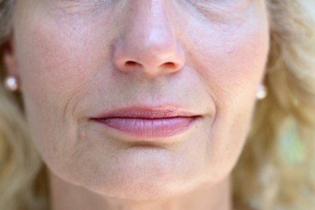 DallasSkin's tweet image. Give your lips &amp;amp; lines some love! 👄💗 #Juvéderm works to add volume to the lips while filling in lines around the mouth. This procedure takes only 15-30 minutes, making it ideal for a lunch break appointment. Our team will have you back to work with a confident fresh face!