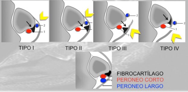Dr. Sergio Hortelano (@drsergiohorte) on Twitter photo 🆘👀OJO SI VES ESTO👀🆘
🔵ARRANCAMIENTO RETINÁCULO PERONEO SUPERIOR🔵
🔶Pueden desarrollar: 
✅DOLOR CRÓNICO
✅SUBLUXACIÓN TENDONES PERONEOS
✅INESTABILIDAD ANTEROLATERAL.
👁🗨RMN Cortes axiales ✔️ 🆘👀OJO SI VES ESTO👀🆘
🔵ARRANCAMIENTO RETINÁCULO PERONEO SUPERIOR🔵
🔶Pueden desarrollar: 
✅DOLOR CRÓNICO
✅SUBLUXACIÓN TENDONES PERONEOS
✅INESTABILIDAD ANTEROLATERAL.
👁🗨RMN Cortes axiales ✔️