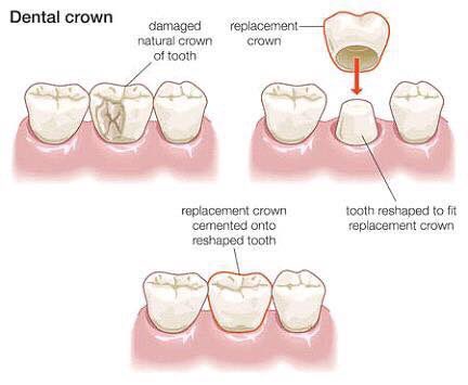 This is what happens when your tooth needs a crown. The tooth is cleaned of decay and reshaped to for a custom crown. Saving the original tooth & it’s root structure is always a priority! #DentalCrowns #SaveYourTeeth #SaveDontRemove #EffectiveDentalTreatment #Crowns #DamagedTooth