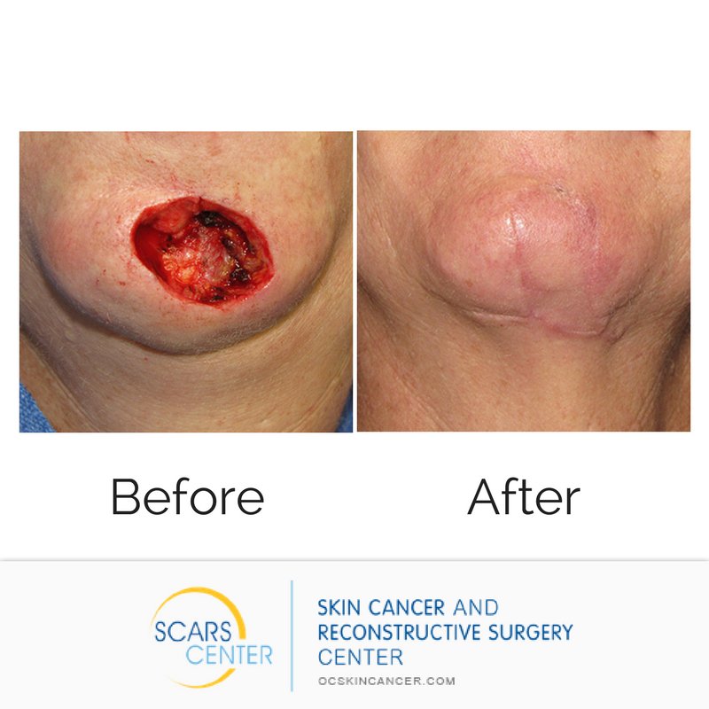 SCARSCenter's tweet image. GRAPHIC: As the year comes to a close, please remember your skin checks and your overall #health in general. If you take care of your body, it will take care of you. Sunscreen also makes a meaningful gift. For skin checks and #sunscreen call: (949) 719-1800