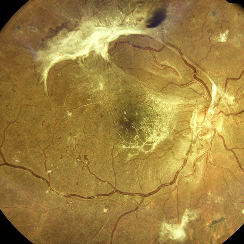 Reposting @brooklyneyecenter:
...
"Lots of neovascularization and severe tractional epiretinal membrane formation in this 30 year old male diabetic #retina #ophthalmology #optometry #diabetes"