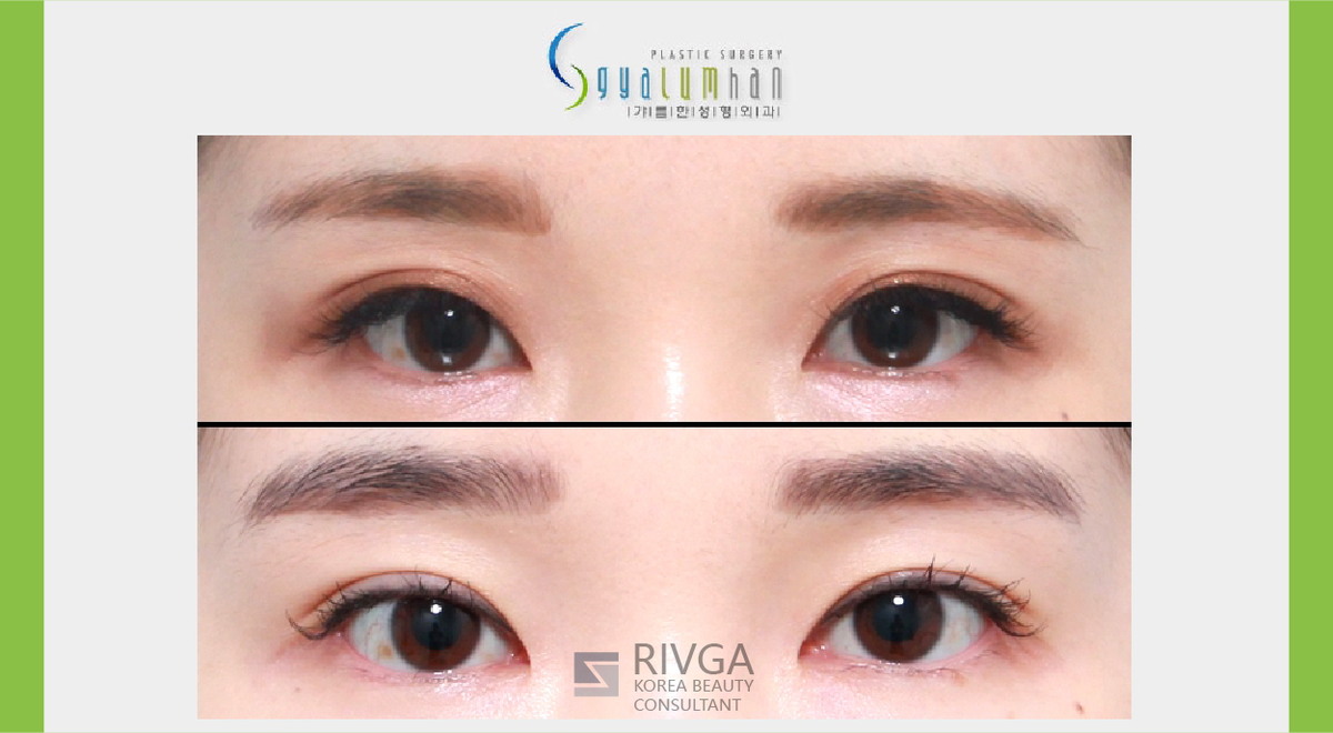 Korea Beauty Consultant Rivga 初対面では まず初めに相手を見る場所が目です 目が綺麗と相手の印象も良く感じられます 二重整形 目の再手術 目頭切開 目つき矯正 ぱっちり 大きい目